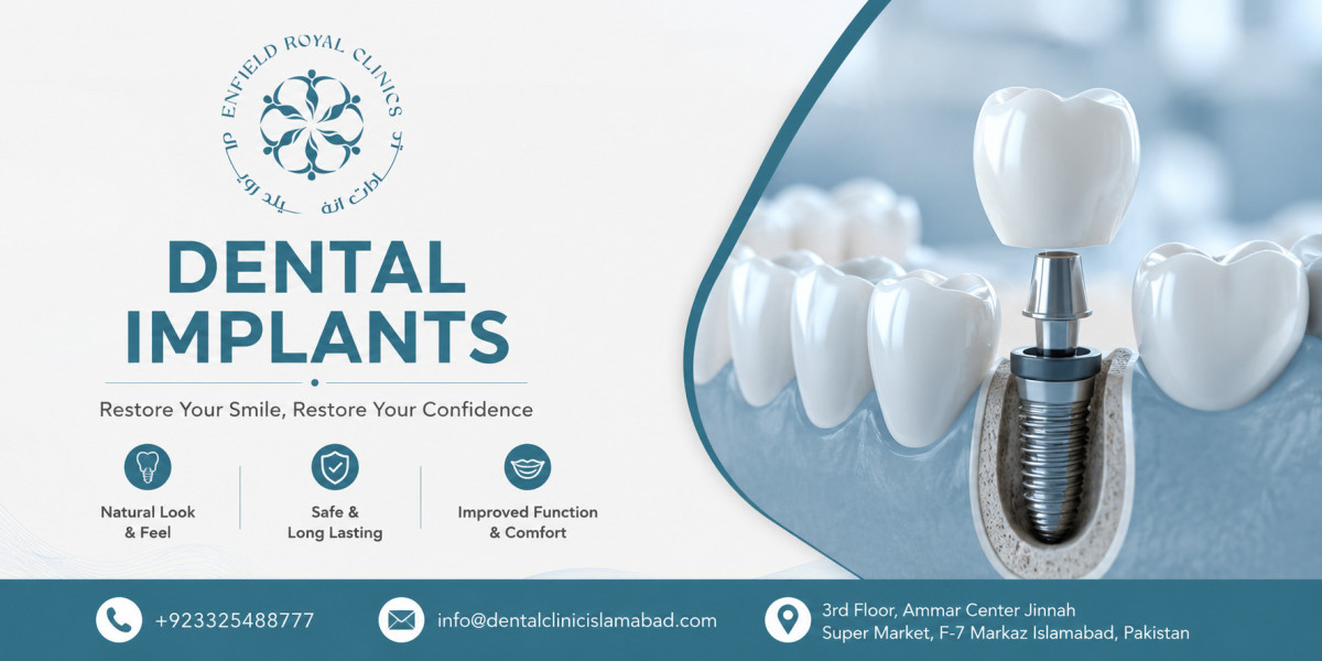 Everything You Need to Know About the Best Dental Implants in Islamabad