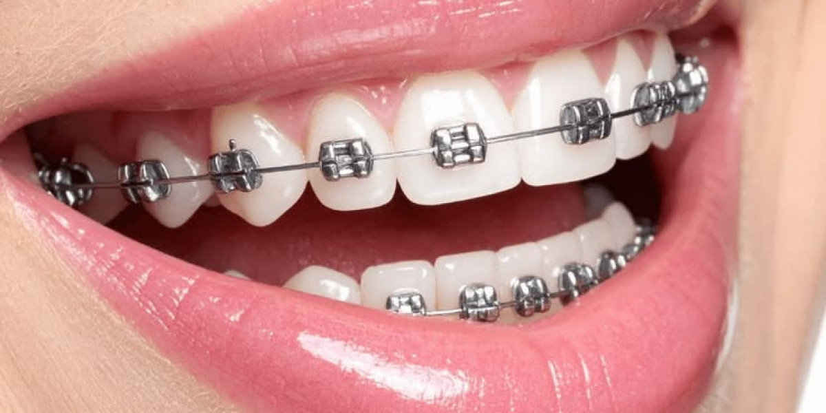 Dental Braces: A Step Toward Lasting Confidence